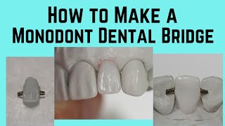 How to make a monodont dental bridge. The steps for making a Mondont dental bridge.