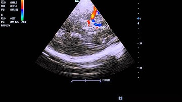 transcranial doppler
