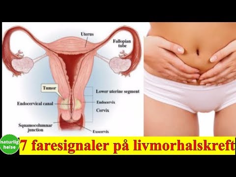 Video: Symptomer på livmorfibroider