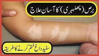 Sufaid Dagh Yani Kay Leucoderma Ka Asan Tareqa Leucoderma Finish Urdu Video