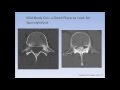 The Spondylolysis / Spondylolisthesis Lecture