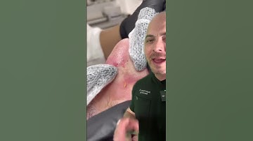 Doctor reacts to super satisfying pimple popping! #dermreacts #doctorreacts #pimplepop