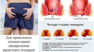 Как выглядит геморрой у мужчин: фото, начальная стадия, признаки, симптомы