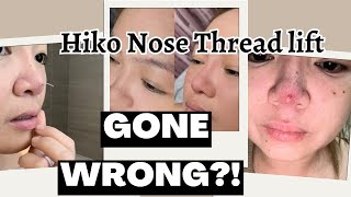 My Hiko Nose Thread Lift Experience Part 1| What went wrong?|Non-invasive rhinoplasty