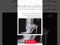 هذه هي خطورة ارتداء حذاء الكعب العالي صورة تحت الأشعة تظهر الخطورة 