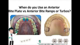 When is it better to us an Anterior Bite Plate vs Anterior Bite Turbos?