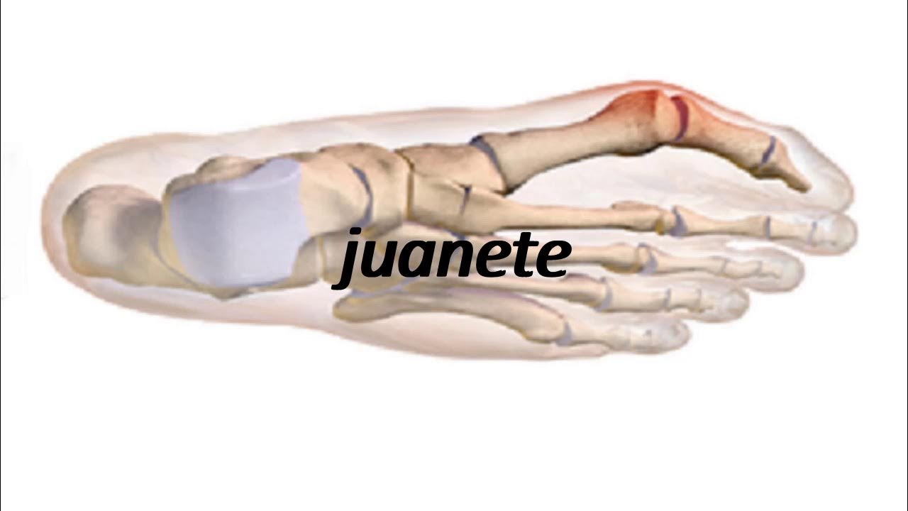 How to say bunion in Spanish? YouTube