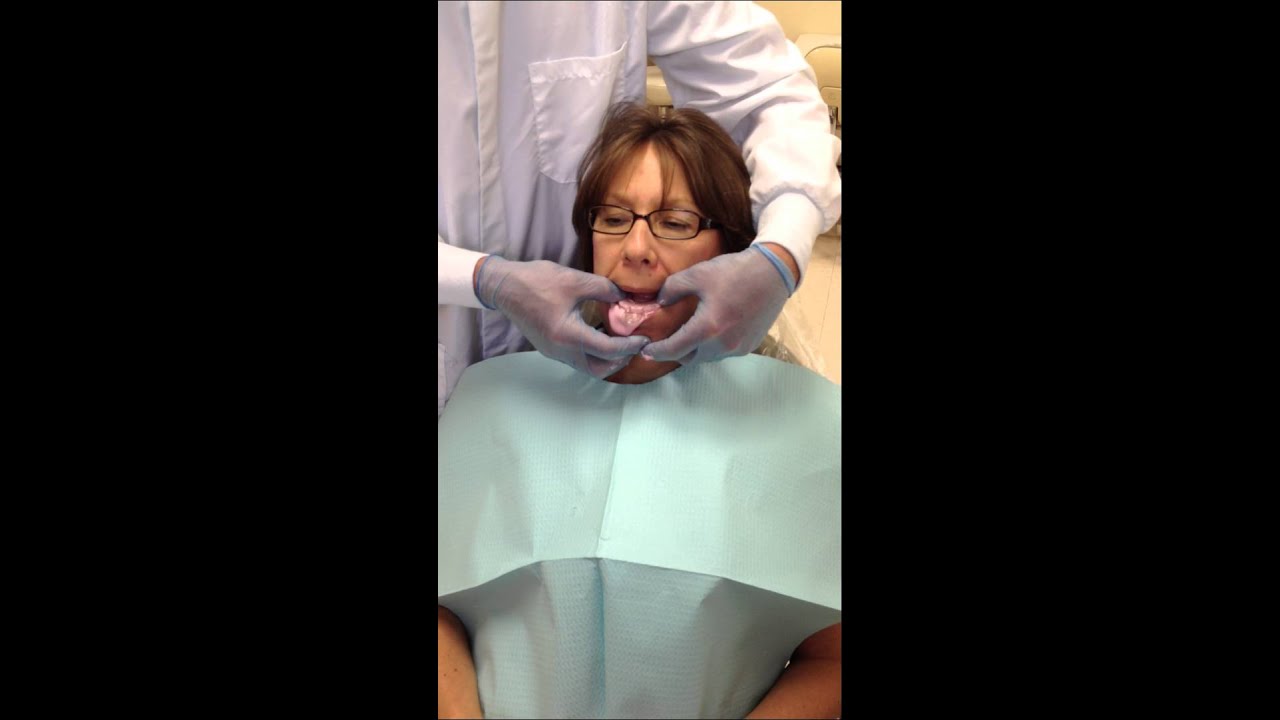 Mandibular Alginate Impression