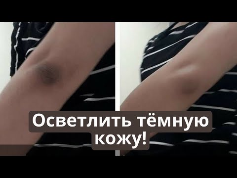 Видео: 3 способа осветлить темные колени