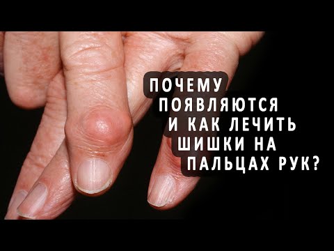 Почему появляются и как лечить шишки на пальцах рук?