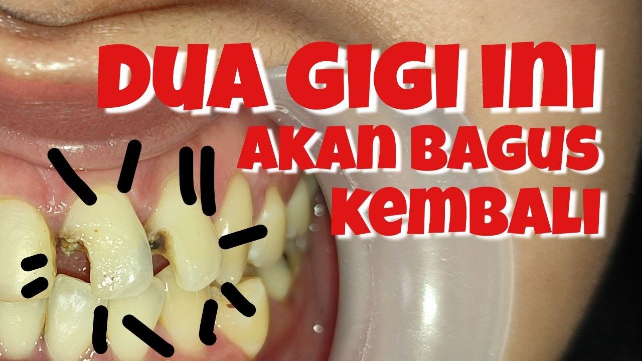GIGI DEPAN RUSAK ??? KITA PERBAIKI.. TOOTH BROKEN RESTORATION - YouTube