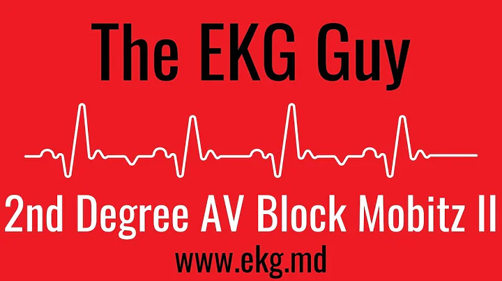 Second Degree AV Block Mobitz II EKG l The EKG Guy - www.ekg.md