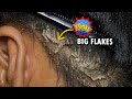 Psoriasis Scalp Scratching Big Flakes!!! Dandruff Removal Satisfying #322