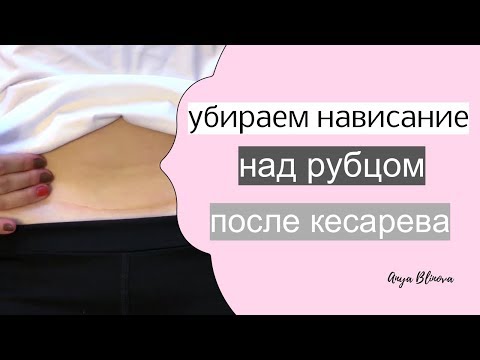 КАК УБРАТЬ ЖИВОТ ПОСЛЕ КЕСАРЕВА | пара простых процедур