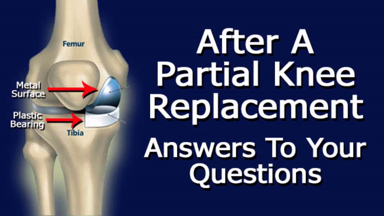 After Partial Knee Replacement Surgery Answers To Your Questions Youtube