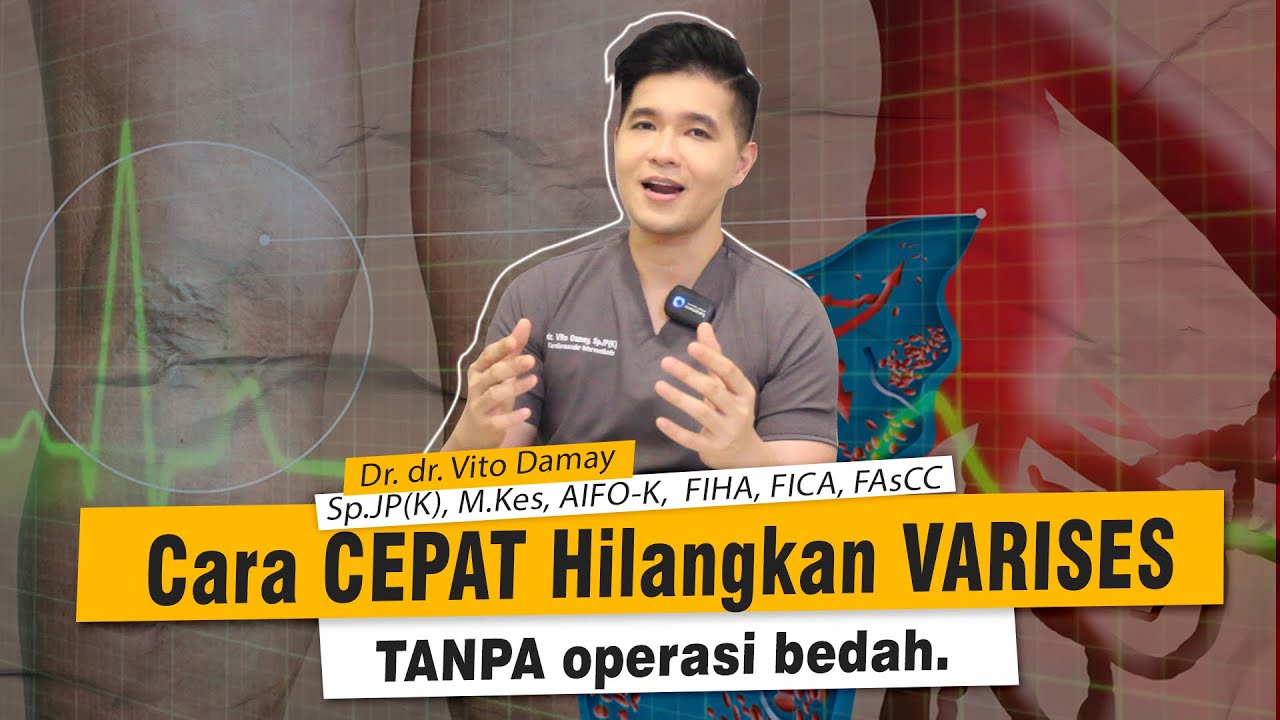 Dr Vito | Hilangkan VARISES tanpa pembedahan