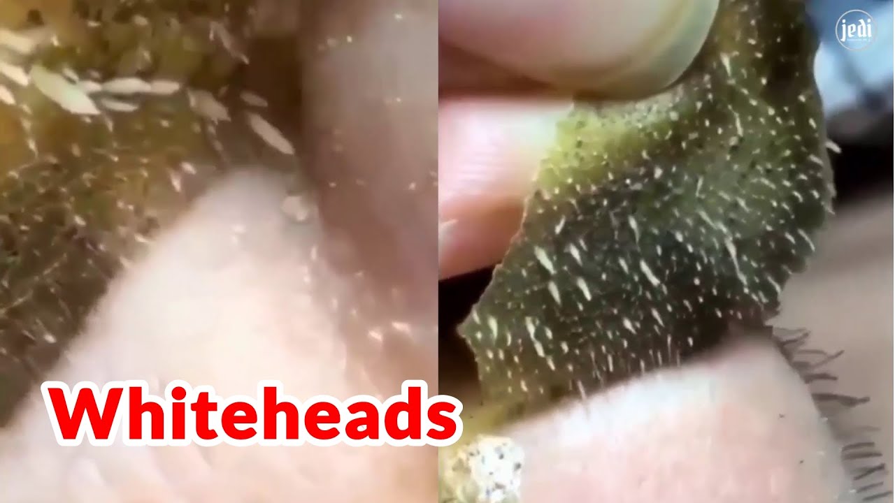 Instruere transfusion Miljøvenlig Relaxing peel off whitehead mask close up| Pore strips removal satisfying  video - YouTube