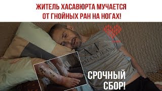 Житель Хасавюрта мучается от гнойных ран на ногах! Житель Хасавюрта мучается от гнойных ран на ногах!