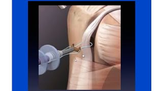 Arthroscopic Biceps Tenodesis