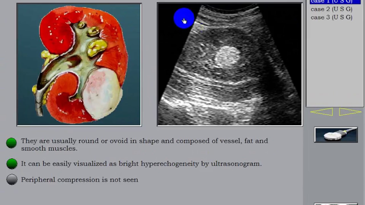 Ultrasound Of The Kidney 7 Renal Tumors Youtube