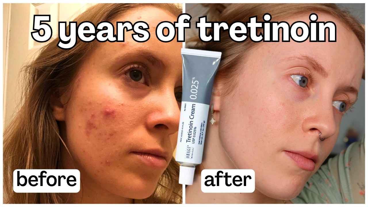 Top Tips to Use Tretinoin/Retin-A Without Irritation! 5 YEAR Before & After (Tretinoin Cream 0.025%)