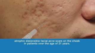 Bellafill® for Acne Scar Proposed Mechanism of Action