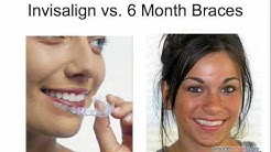 6 Month Smiles FAQ | Invisible Braces for Adults