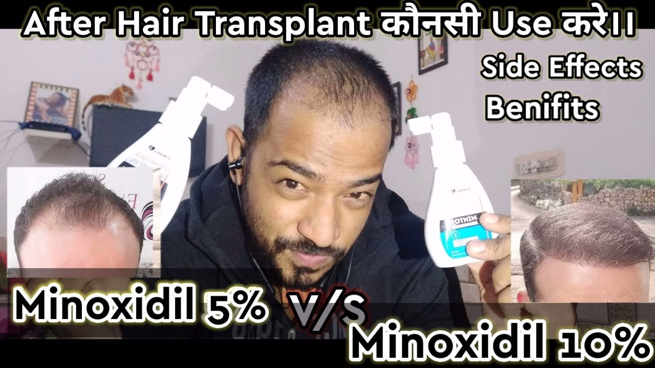 hair-transplant-results-minoxidil-5-vs-minoxidil-10-minoxidil