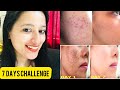 7 days challenge - Remove Dark Spots , Acne Marks, Dark Circle || Korean Inspired Skin Repair Cream