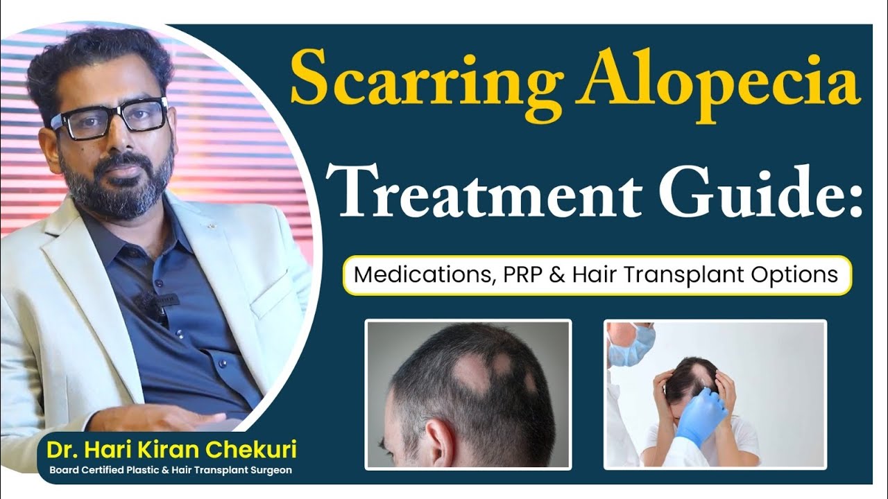 Scarring Alopecia Treatment Options: Medications, PRP & Hair Transplant #HairLossTelugu