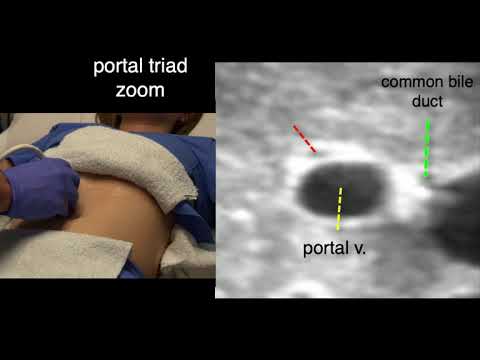 Gallbladder Scan Techniques, Subcostal Midclavicular Window