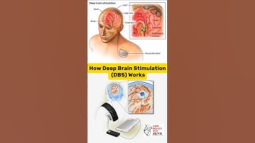 How Deep Brain Stimulation (DBS) Works #animation #3d #short