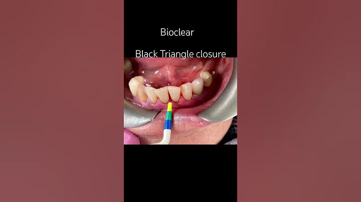 #bioclear #smilemakeover #antiaging #smilemore #healthtips