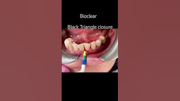 #bioclear #smilemakeover #antiaging #smilemore #healthtips