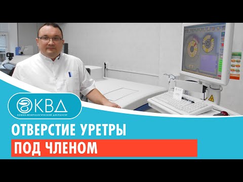 Отверстие уретры под членом. Клинический случай №698