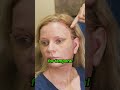 1 week after deep plane facelift recovery cosmetic face goviral
