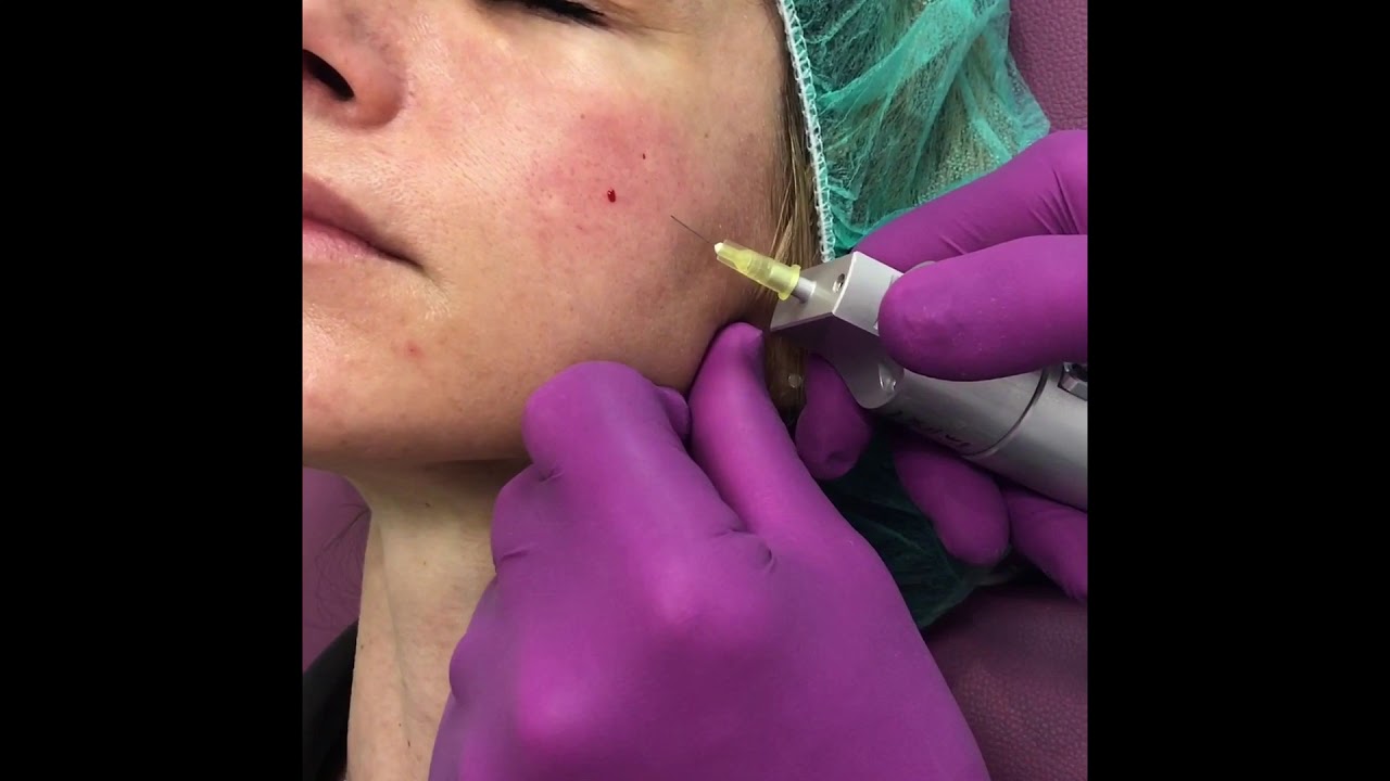 Carboxy Therapie - YouTube