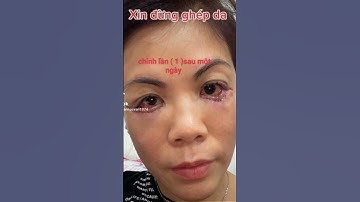 Mí mắt dưới bị lật ngửa thì xin đừng ghép da/Thẩm Mỹ Thành Công.