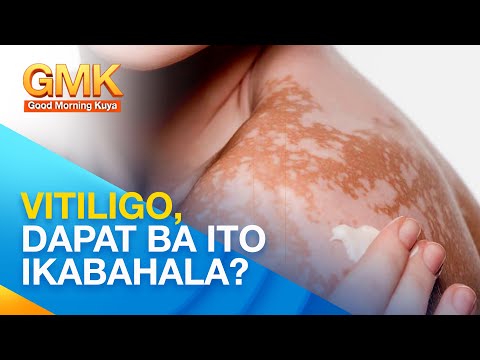 Video: 3 Mga Paraan upang Gamutin ang Vitiligo