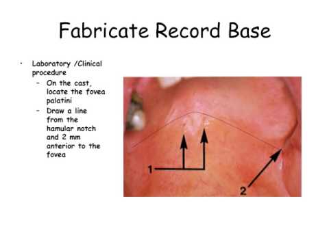 hamular notch