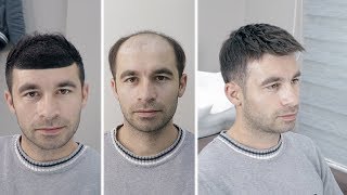 PROTEZ SAÇ - Hair Replacement Resimi