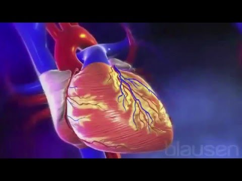 Video: Diferența Dintre Atac De Cord și Accident Vascular Cerebral