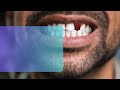 Benefits of dental implants