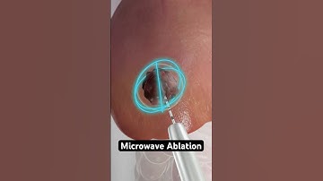 Using microwaves to destroy cancer cells (3D Animation)