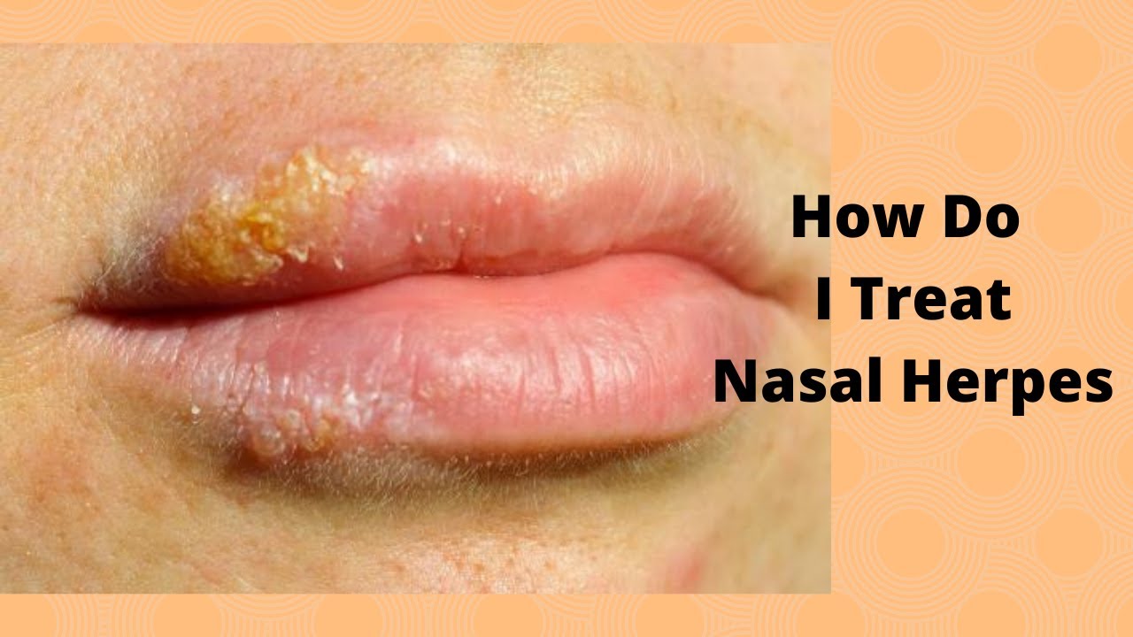 How Do You Know If You Have Herpes In Your Nose