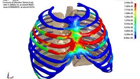 LS-DYNA Examples - Smoker’s lung during breathing