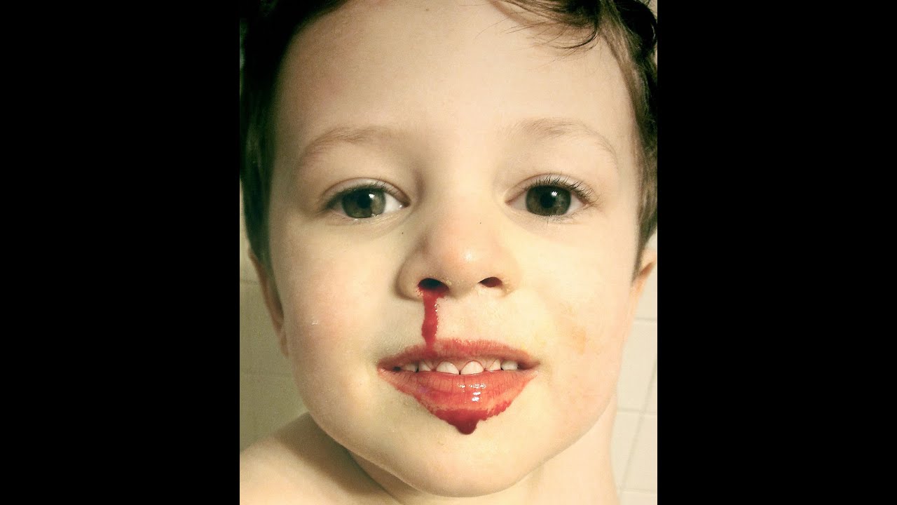 Control of Nasopharyngeal Hemorrhage CPT code simplify medical coding