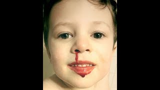 Control of Nasopharyngeal Hemorrhage CPT code - simplify medical coding