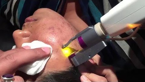 Erbium YAG Laser Skin Resurfacing - Skin rejuvenation