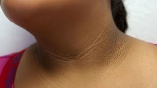 ما هو الشواك الاسود؟ماهي الاسباب،الاعراض و العلاج؟ Acanthosis nigricans, سواد الرقبة،hypothyroidism